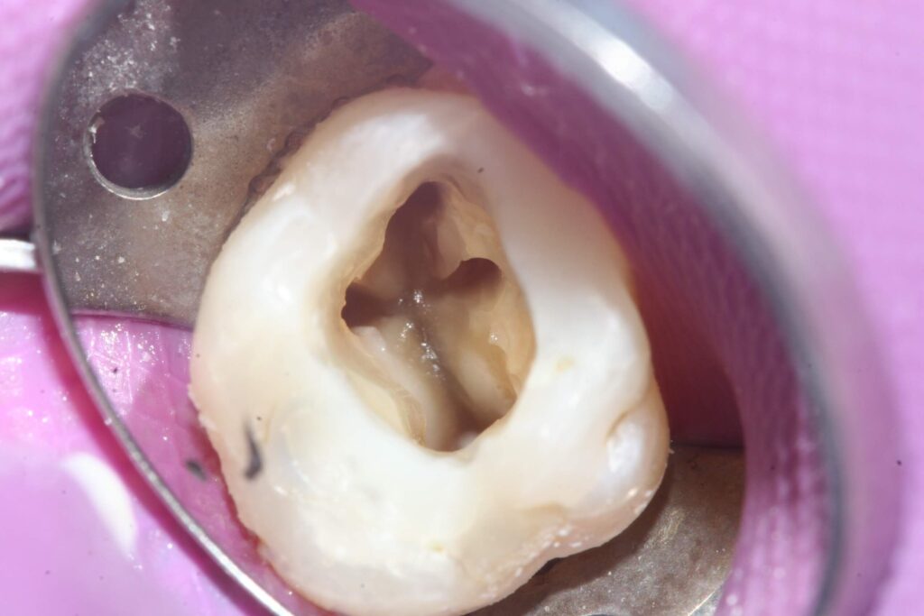 Traitement de canal dentaire new smile clinic