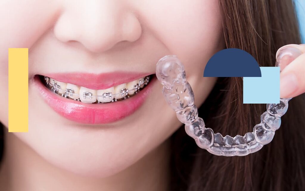 Appareil orthodontique invisible new smile clinic